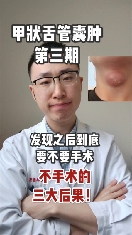 甲状舌管囊肿要不要手术