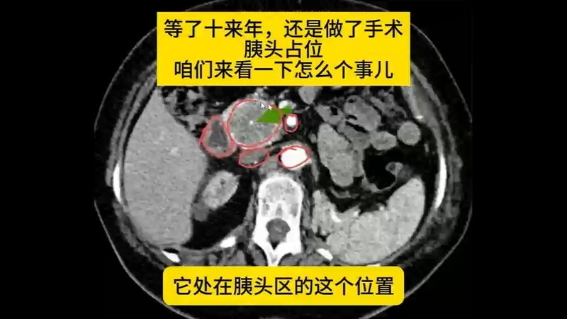 胰头占位，让我们来看一下是良性的还是恶性的