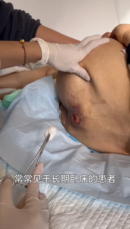 褥疮，使用泡沫敷料操作视频
