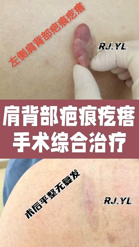 皮肤疤痕疙瘩的手术综合治疗