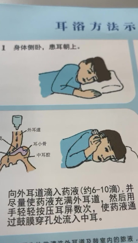 如何给耳道点药，耳浴示意图