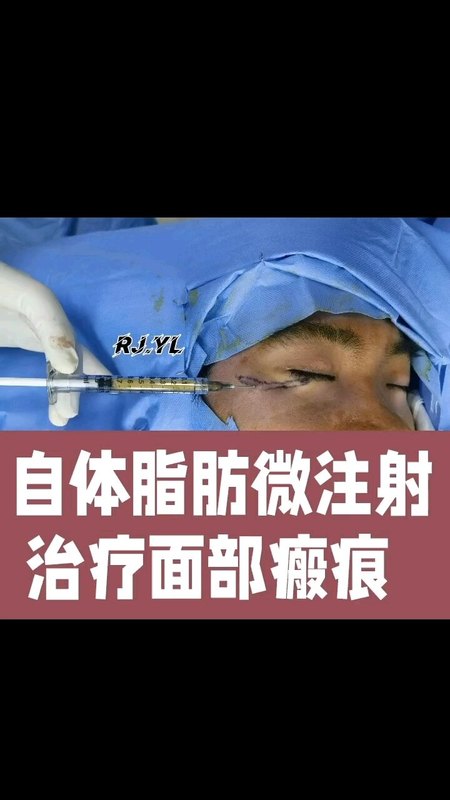 自体脂肪干细胞微注射治疗凹陷瘢痕