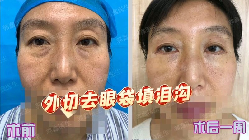 外切去眼袋填泪沟术后一周分享