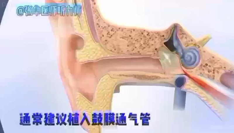 鼓膜置管—渗出性中耳炎等常用处置方案