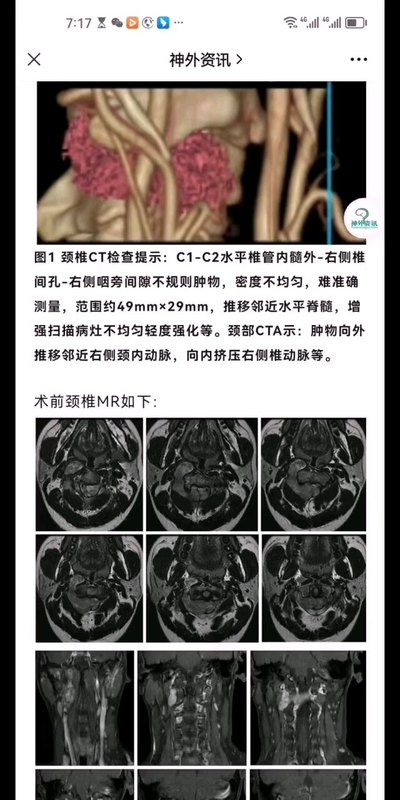 颈椎椎管内复杂肿瘤～