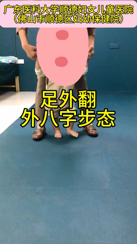 刚学走路的孩子，明显足外翻、外八字步态。
