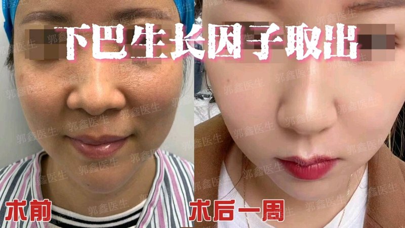 下巴生长因子取出术后一周分享