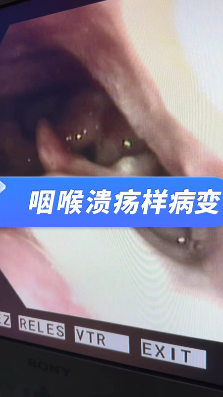 咽喉溃疡样病变