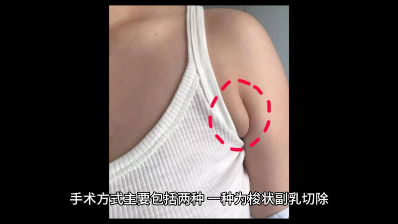 副乳切除手术如何微创治疗