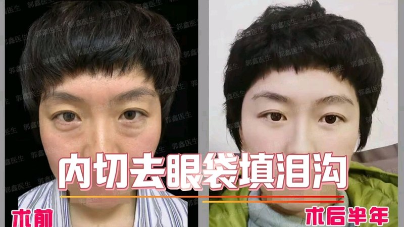 内切去眼袋填泪沟术后半年，年轻又漂亮