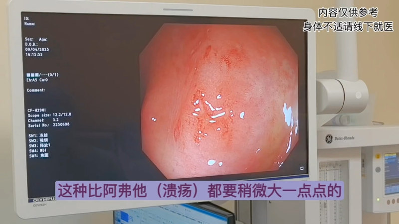 克罗恩病的内镜早期特征是什么样的？