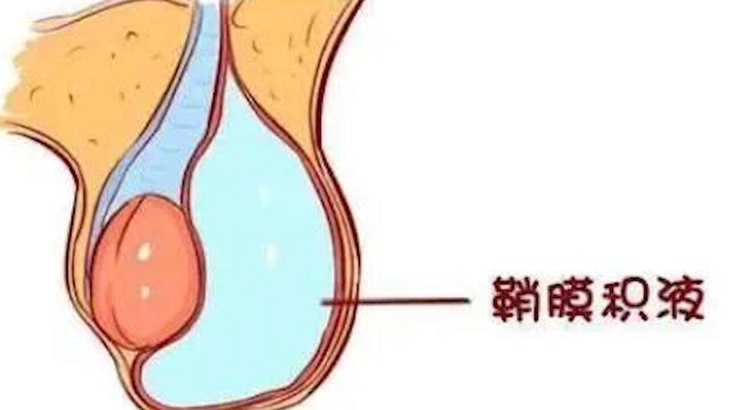 疝气鞘膜积液的病因、手术、手术后注意事项