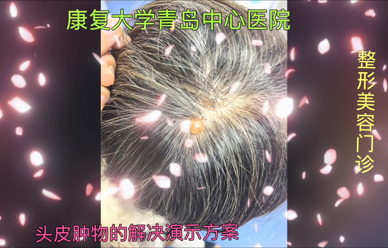 头皮肿物