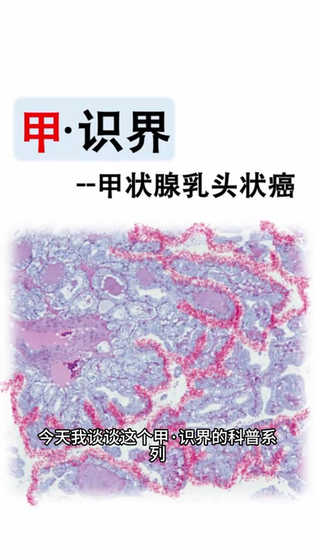 甲状腺乳头状癌的手术及相关问题
