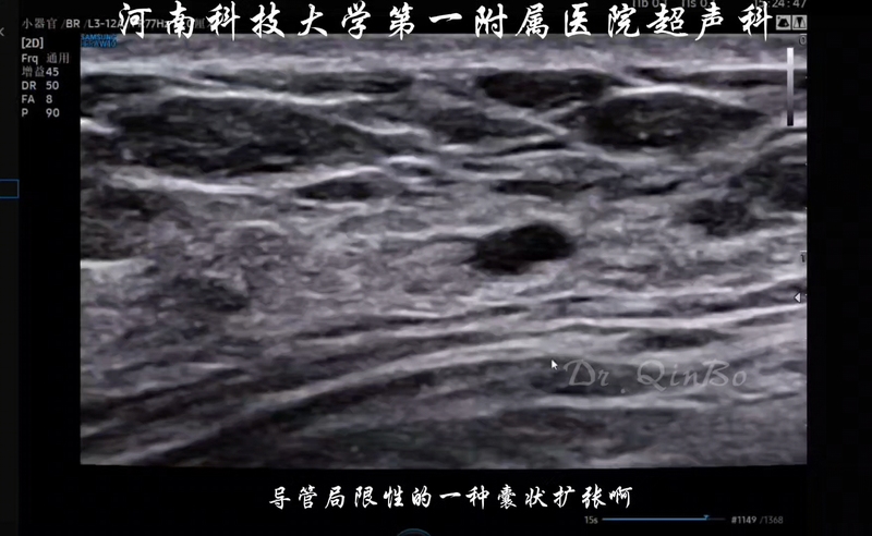 乳腺导管扩张我们重点在哪里