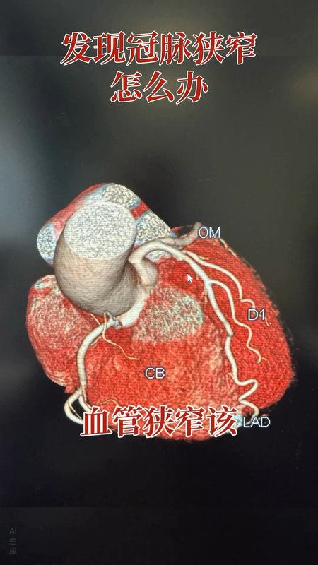 冠脉CTA查出问题怎么办？