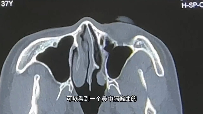 鼻中隔偏曲，早治疗，早健康