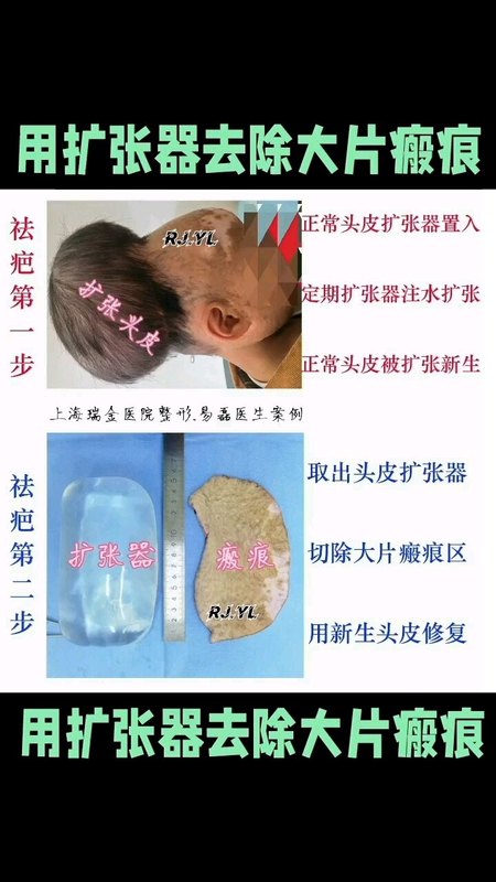 应用扩张器技术去除大片陈旧性瘢痕