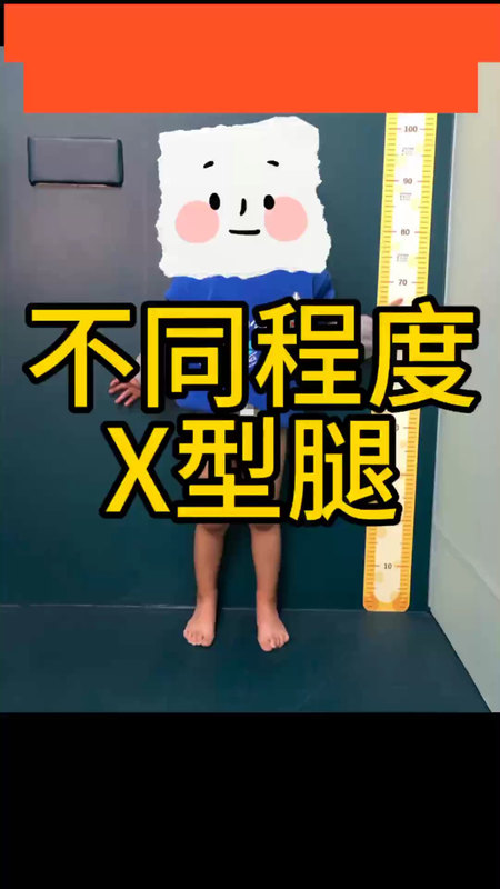 都是2岁9个月，都是X型腿，为什么差别这么大呢？