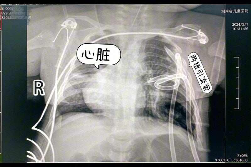 心脏回家（危重先天性肺囊状腺瘤样畸形的治疗）