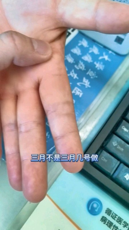 腱鞘炎切开松解术后还痛，早中期建议保守治疗和微创治疗，手术松解是二线方案