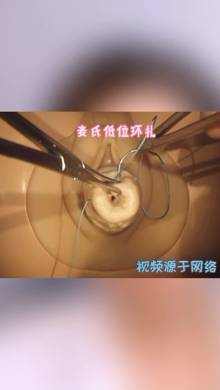 揭开“宫颈环扎术”的神秘面纱，来看看宫颈环扎是怎么做的？—-宫颈机能不全早产专题