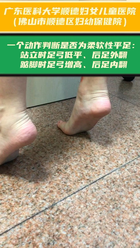 一个动作判断是否为柔软性平足：
                    站立时足弓低平、后足外翻，踮脚时足弓增高、后足内翻。