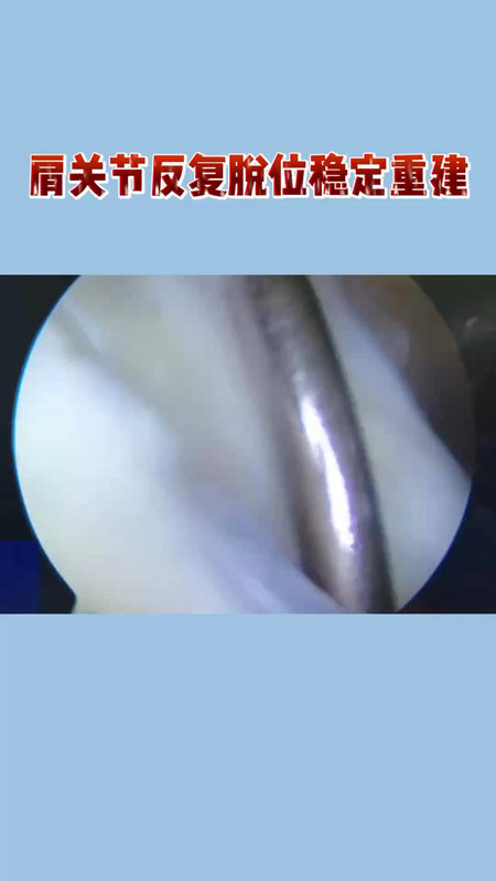 肩关节反复脱位稳定重建