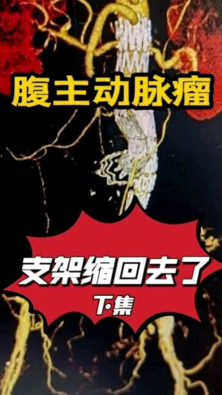 腹主动脉瘤支架缩回去了会怎样？怎么办？（下集）