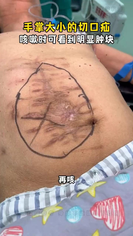 腹部巨大切口疝 咳嗽时明显