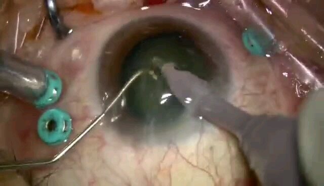 视网膜分支静脉阻塞伴玻璃体积血PPV手术视频