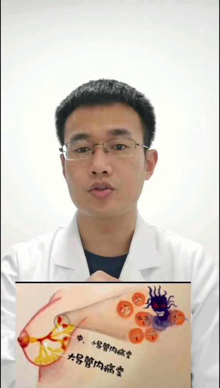 乳腺导管内乳头状瘤1