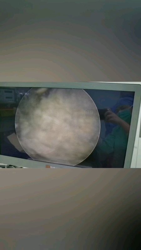 陈叔，今日全麻下完成微创经尿道前列腺电切术，术中同时发现膀胱三角区有两个肿瘤，一并切除送检。