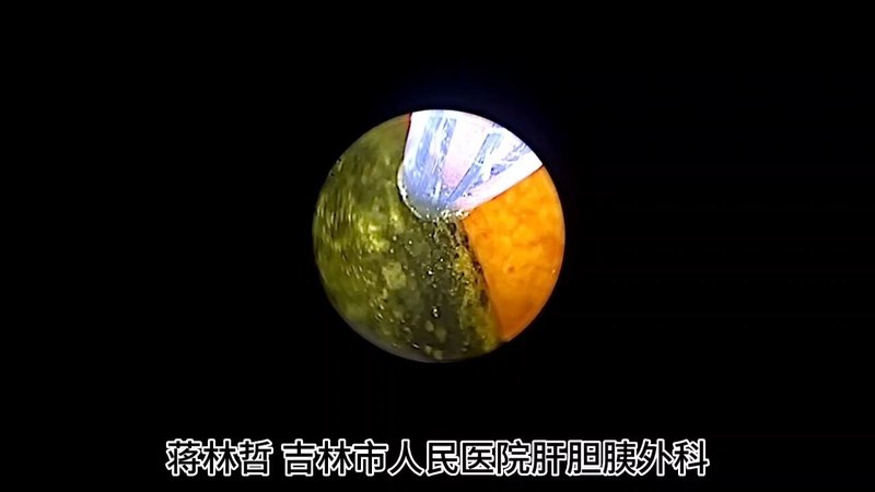 微创保胆取石手术