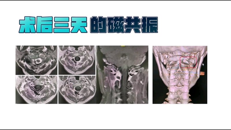 椎管内肿瘤微创治疗系列六