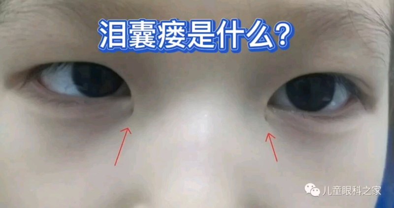 泪囊瘘是什么？