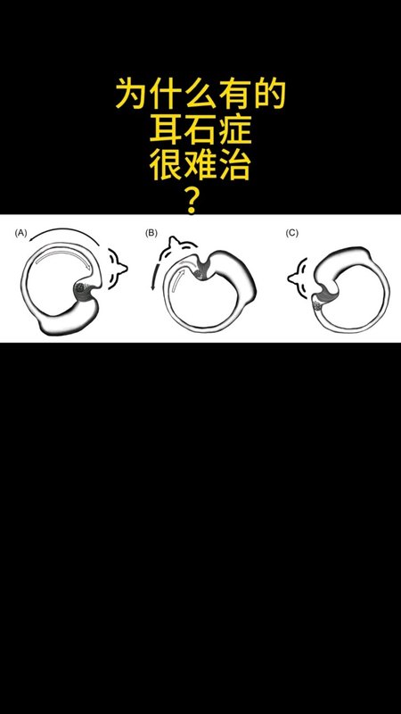为什么有的耳石症很难治？
