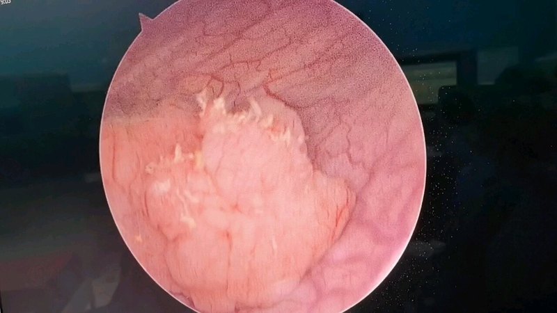 膀胱肿瘤长啥样