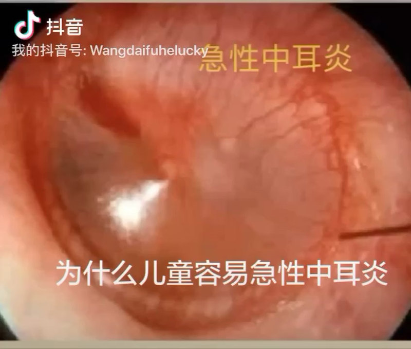 为什么儿童容易得急性中耳炎