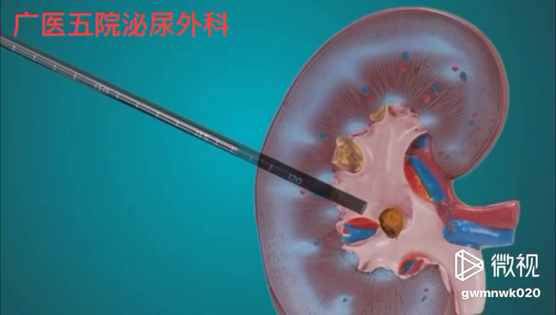 微创经皮肾碎石取石术动画版+讲解，我们单位吴开俊教授及李逊教授是这方面手术开拓者，吾辈谨当继续发扬