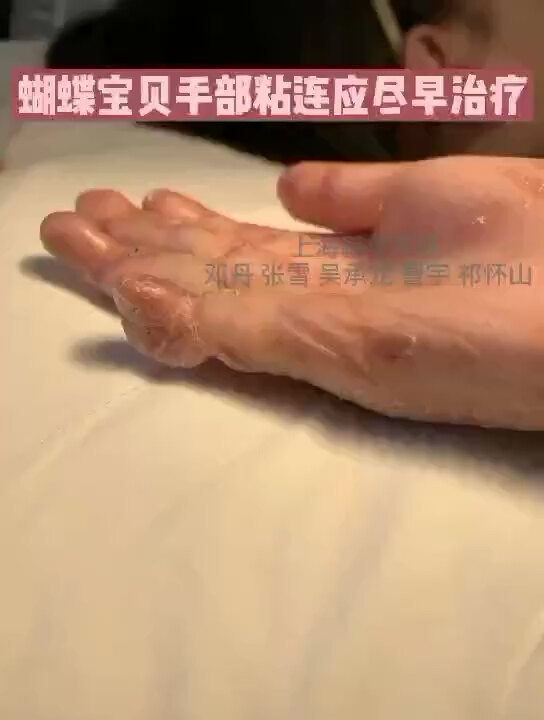 遗传性大疱性表皮松解症，患者后期除了特别容易出现皮肤癌，还很容易因为手指、脚趾的粘连而致畸、致残。
