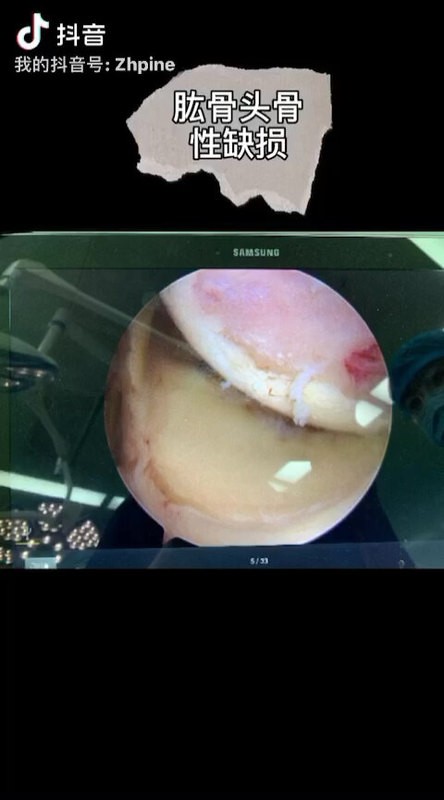 肩关节习惯性脱位，我们拥有领先技术，科学精准修复