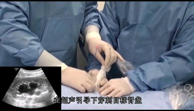 “打洞碎石术”（经皮肾镜碎石术）是怎么做的？