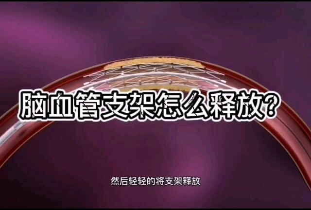 脑血管支架是怎么放的？