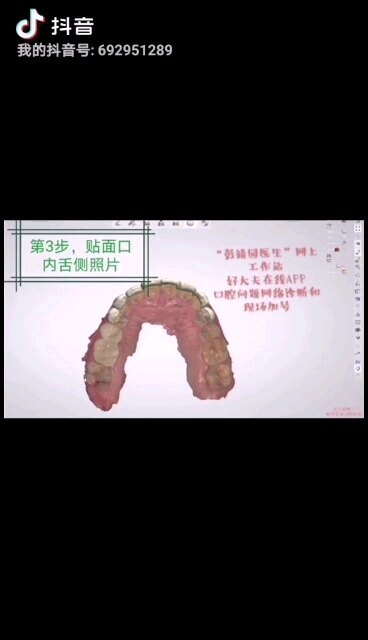 数字化全瓷美学贴面