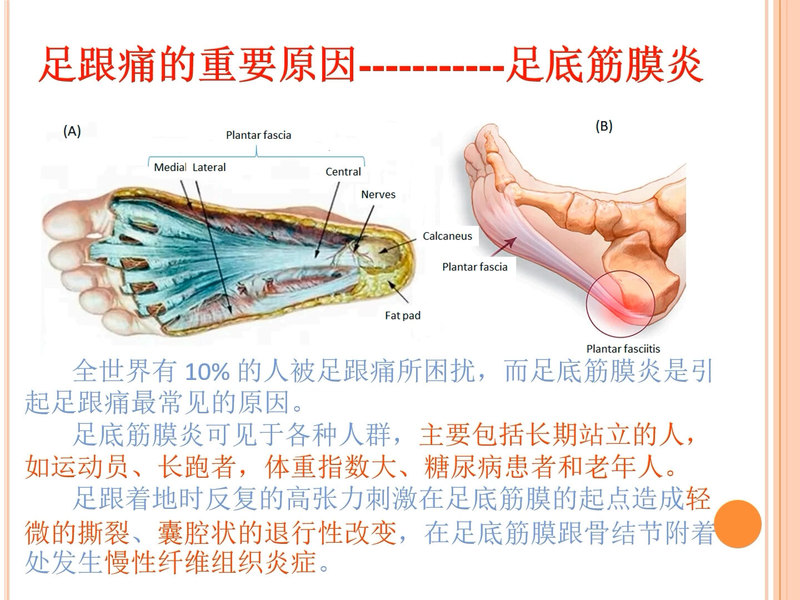 告别足痛：专家详解足底筋膜炎诊疗