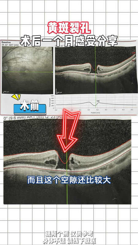 黄斑裂孔手术后分享