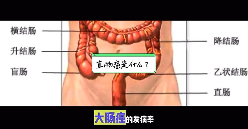 直肠癌是如何发生的？