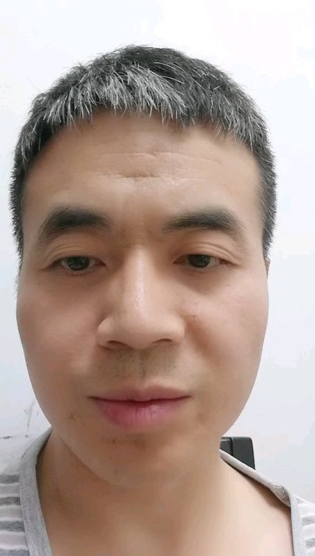 痛风性关节炎症状
