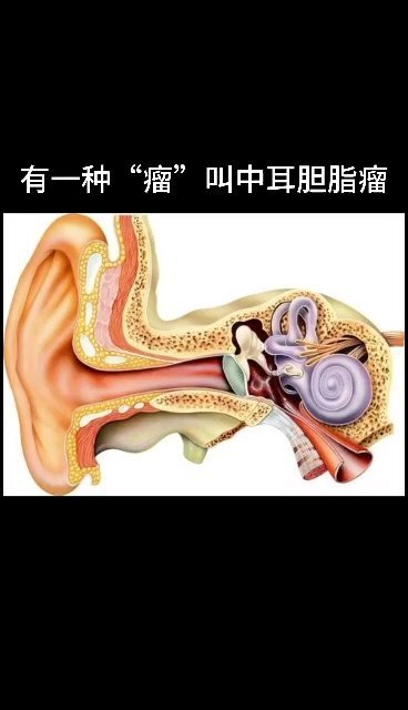 中耳胆脂瘤：不一样的“瘤”，身边有很多，你应该了解下！